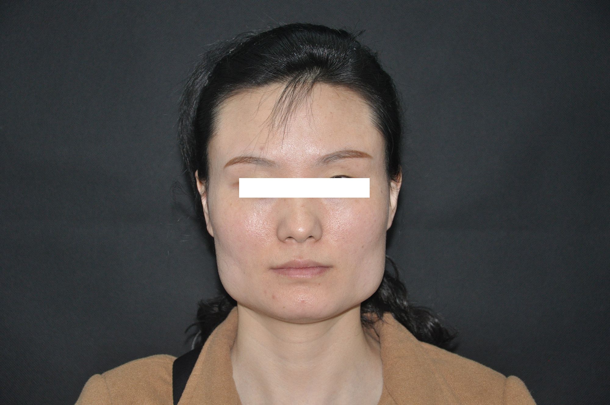 瘦脸针打一次能够达到瘦脸效果吗,瘦脸必看哪些人群不适合瘦脸针