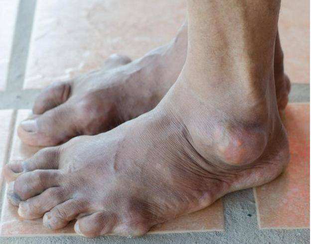 如何鉴别自己患上了痛风,4个常见表现提示你患上痛风啦