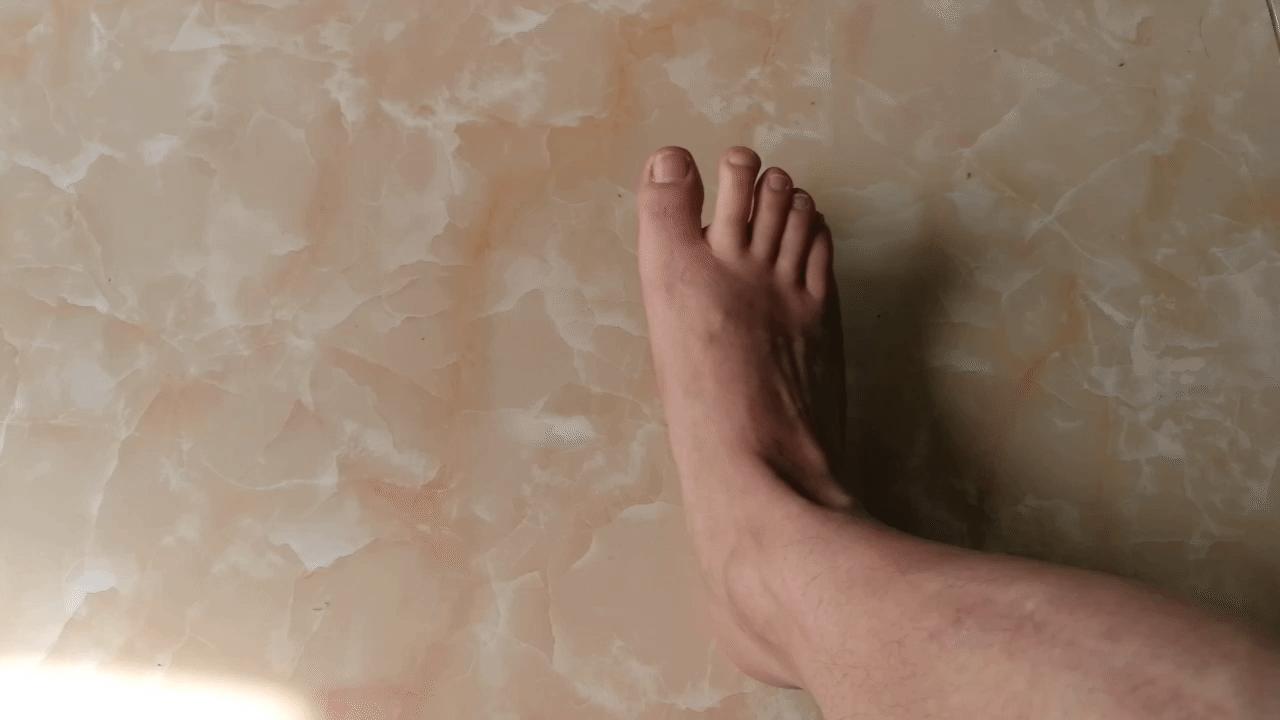 足底筋膜炎痛怎么治疗,足跟痛足底筋膜炎怎么治疗