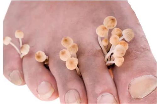 夏天脚气消失冬天脚气又有了,得了脚气香港脚有什么需要注意