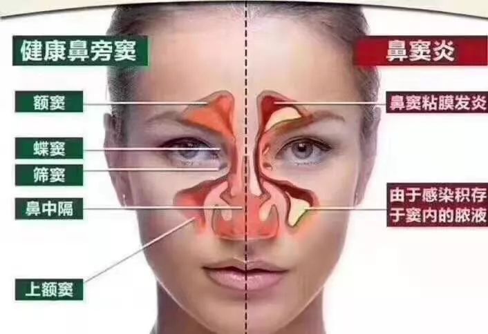 “不可小觑”的鼻窦炎，并发症或直接危害生命
