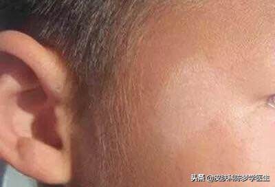 皮肤白斑的症状和治疗方法,皮肤出现白斑吃什么