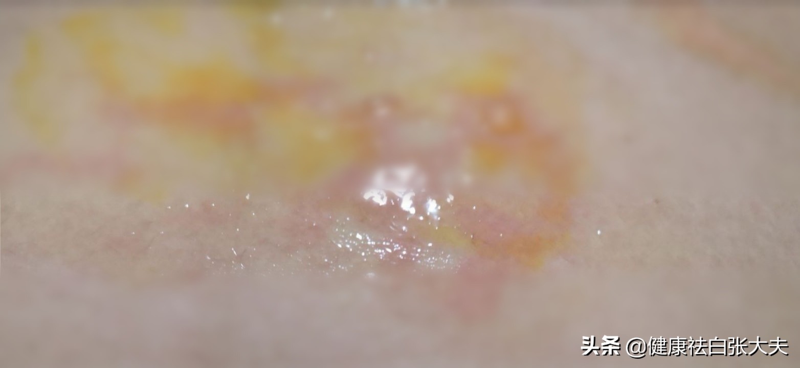 暖宫贴真能治宫寒吗,暖宫贴可以治痛经