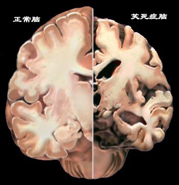 整天笑死了是什么病,笑死症是什么原因引起的