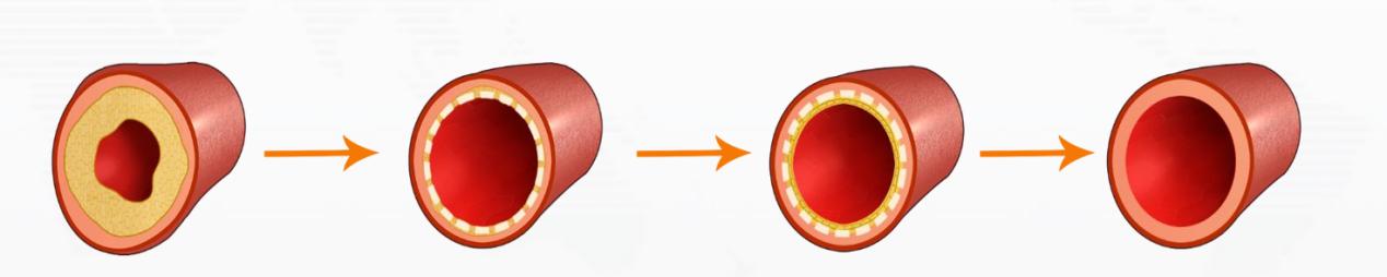 哪个医院开展可降解支架手术,南京市第一医院可吸收支架