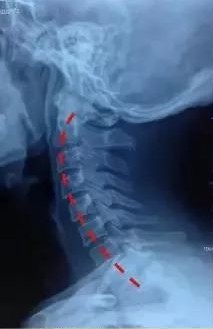颈椎生理曲度变直如何快速治疗,颈椎变直好治吗