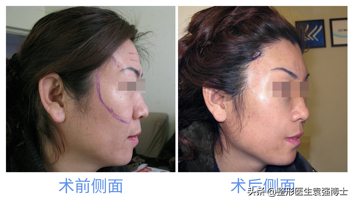 听医生讲副作用,做拉皮手术恢复真实感受