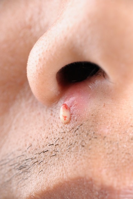 白色有脓的痘痘怎么处理,火疖子白色脓头能挤吗