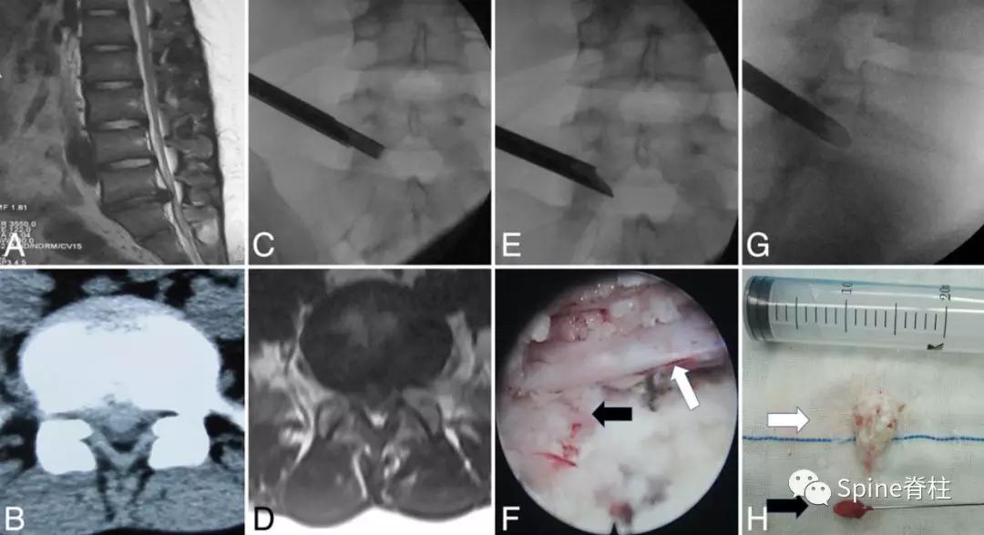 青少年一跑步就腰痛,青少年腰痛是什么原因引起的