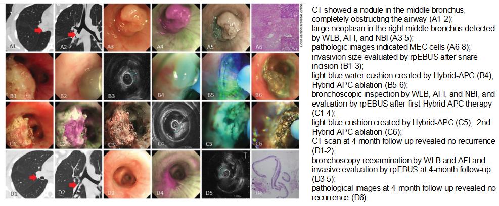 支气管镜高频电刀治疗中央型肺癌,支气管镜在早期肺癌诊断的意义