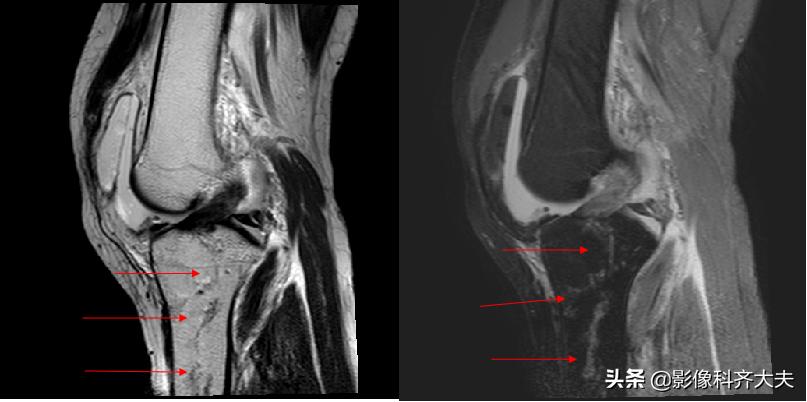 骨折的影像学检查及各自的优势,骨折的影像学愈合标准