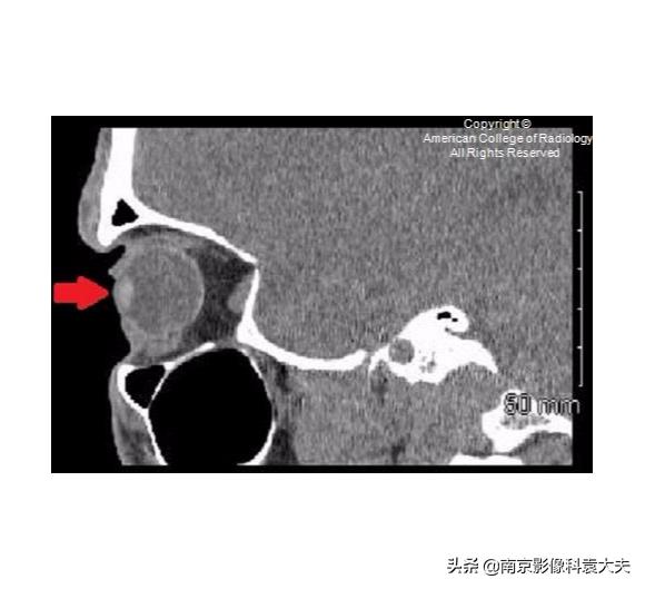 22岁男子眼睛意外失明,中年男子突然右眼失明半小时