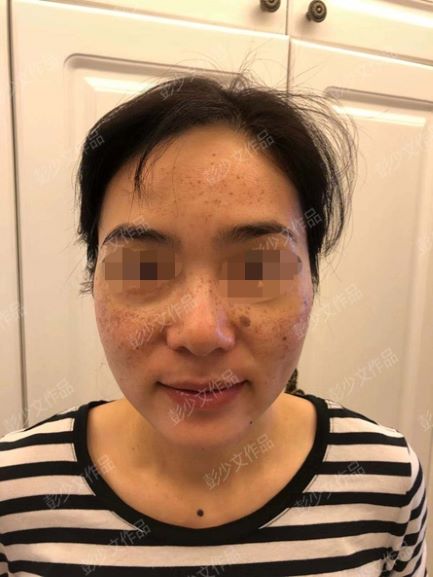 激光祛雀斑亲身经历分享,有没有什么祛雀斑的方法推荐