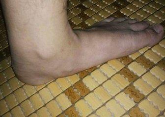 儿童扁平足的最佳治疗方法,全国治疗扁平足前十的医院