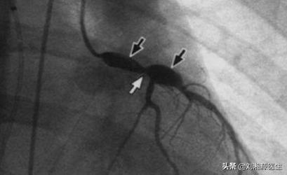 系统性血管炎怀孕能要吗,怀孕得了血管炎怎么办