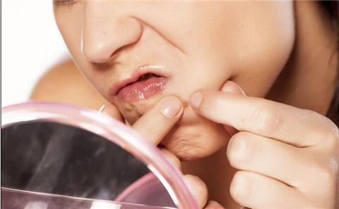 皇家雨燕教你痘痘肌の正确保养方式