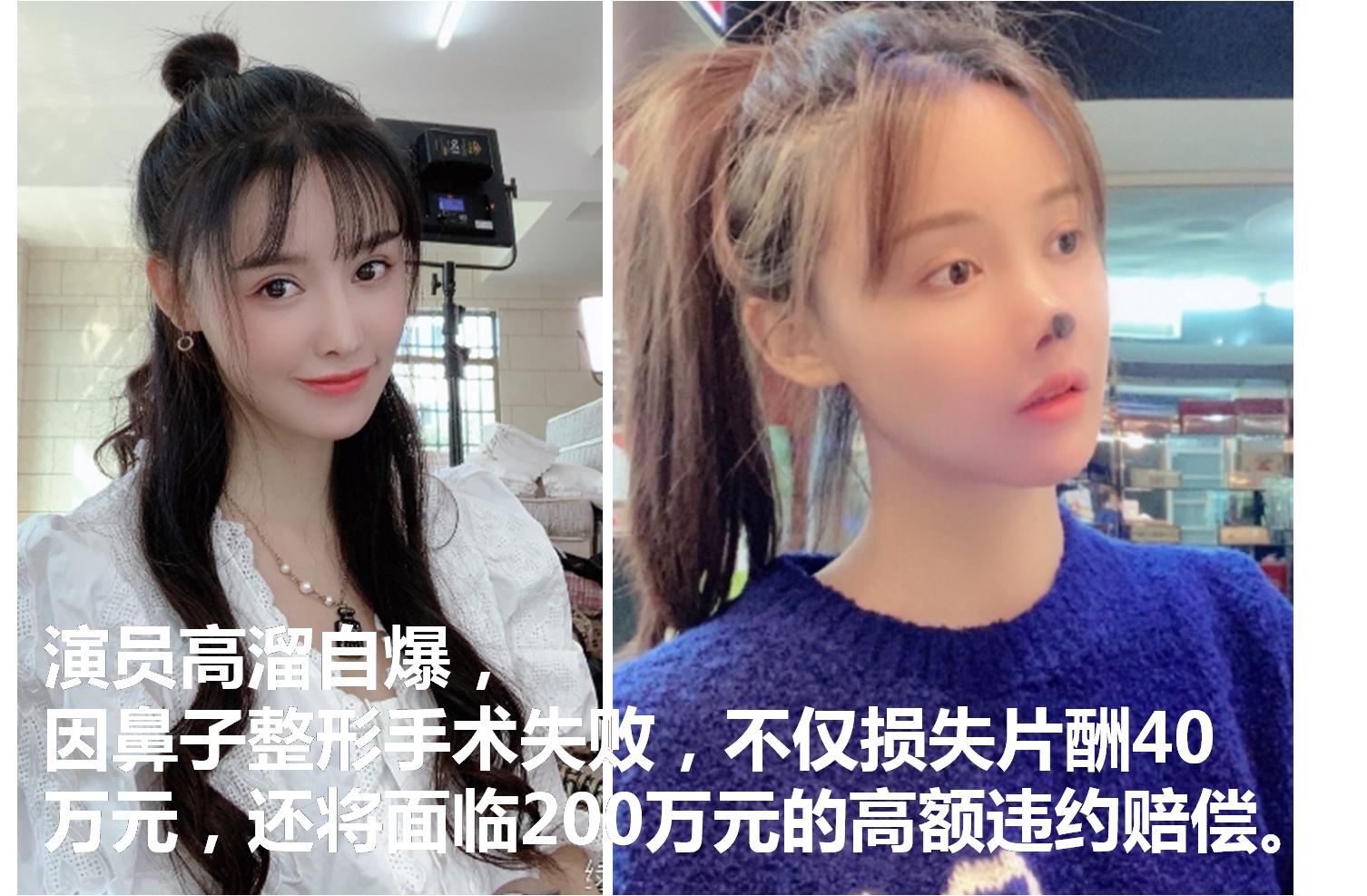 演员高溜整形鼻头坏死。整形换“美”到底值不值？