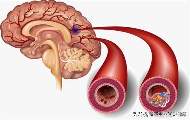 女子连吃20天布洛芬突发脑梗,长期吃阿司匹林的脑血栓患者发烧