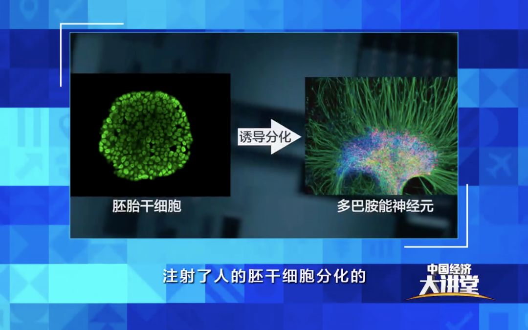 黄斑变性干细胞2020,干细胞治疗黄斑变性新药上市