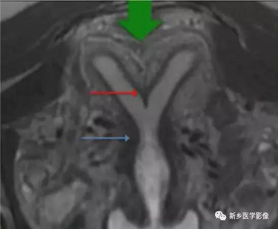 常见的几种子宫畸形诊断标准,先天性子宫畸形是什么原因造成的