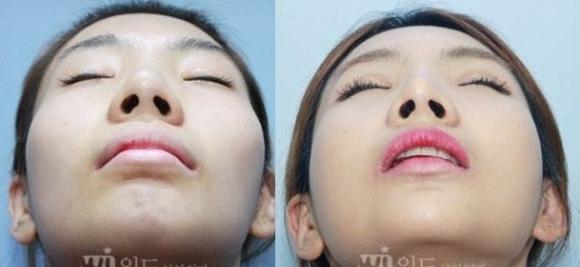 颧骨高适合磨骨还是填充,太阳穴凹陷颧骨突出磨骨