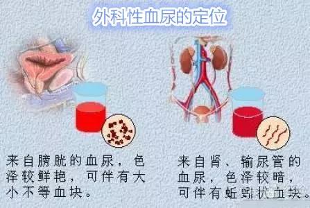 日照市人民医院微课堂——发现血尿怎么办？