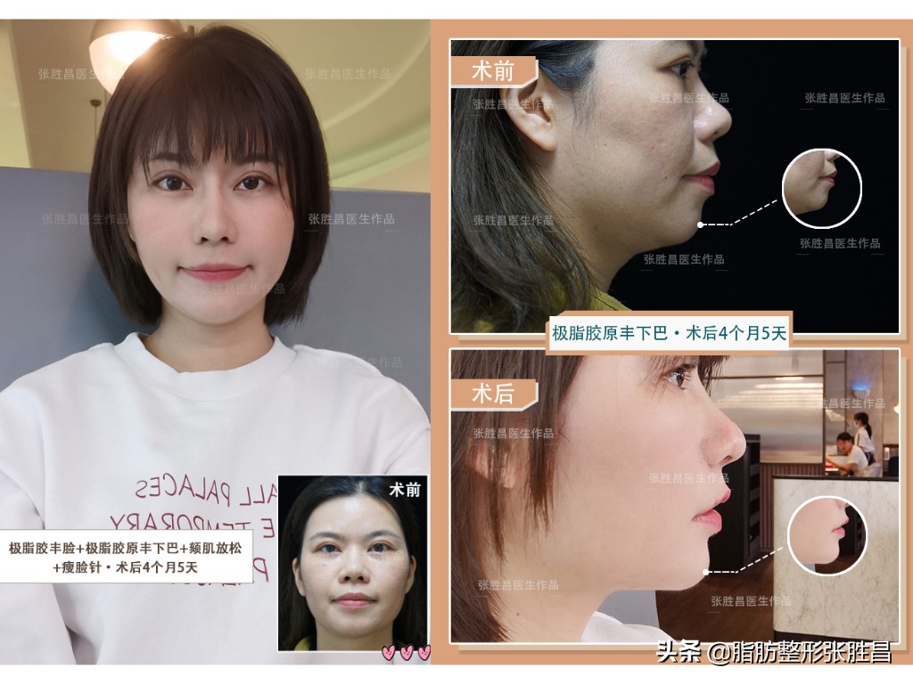 34岁广东女生，颧骨突出显刻薄苦相，脂肪填充后美成人间富贵花