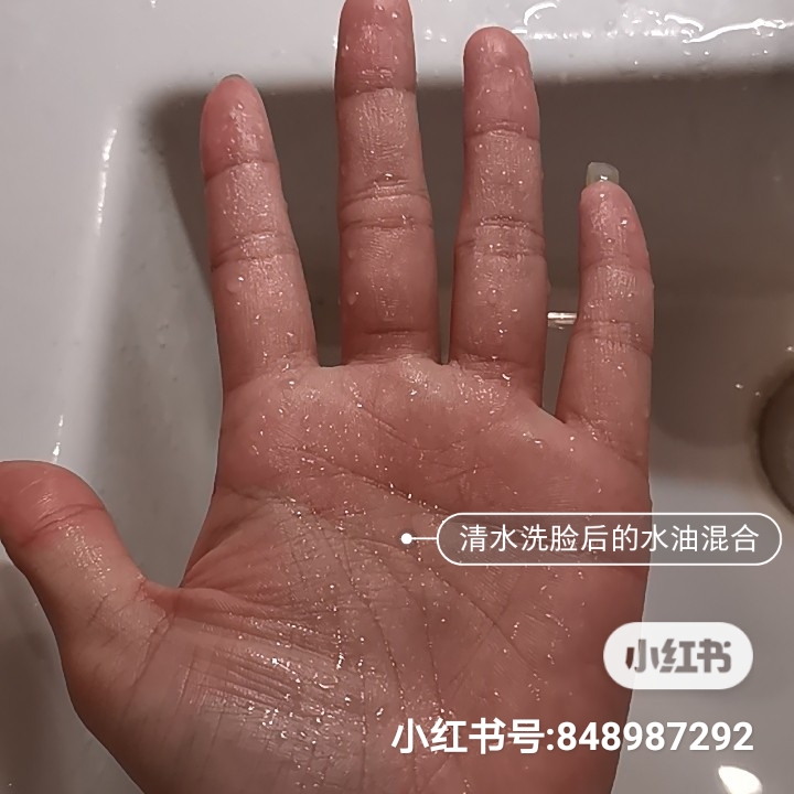 男士毛孔粗大出油痘坑痘印黑头,脸部出油有痘坑痘印毛孔粗大中医