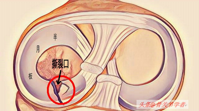 磁共振检查半月板损伤有误诊率吗,半月板磁共振会不会有误诊