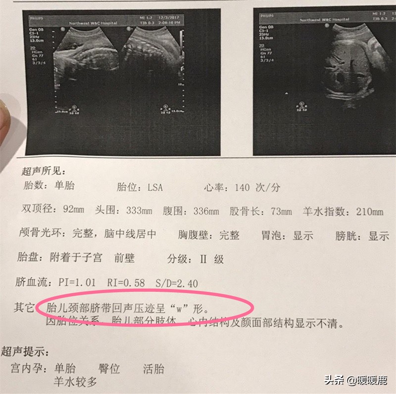 脐带绕颈对胎儿有什么影响,脐带绕颈对胎儿有危害吗