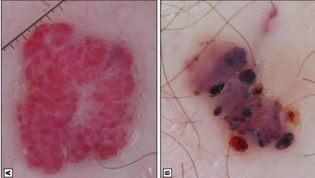 乙肝患者皮肤发黄还意味着什么,乙肝患者皮肤出现红点