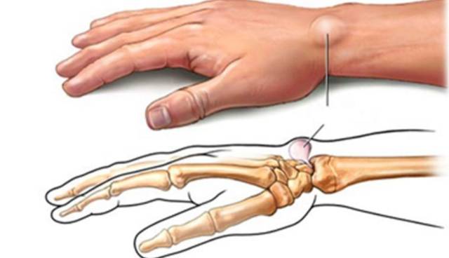 针刀治疗的目的是什么,针刀治疗有什么用