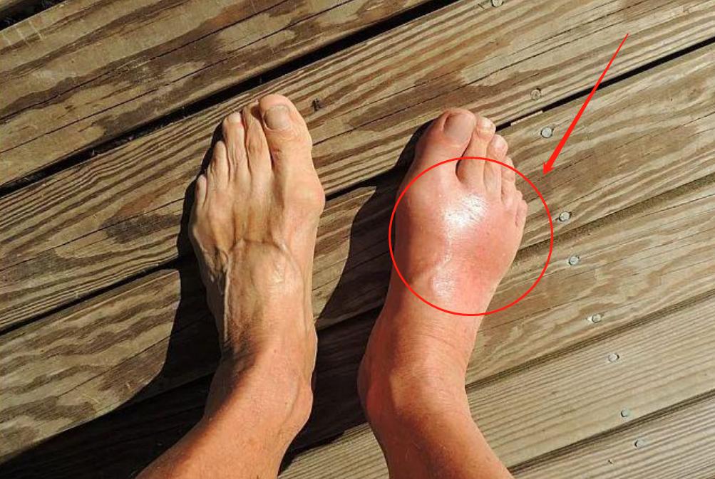 尿酸高通常会引起什么关节痛,尿酸高会引起哪些部位疼痛