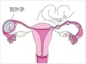 孕早期出血常见,孕早期出血常见吗