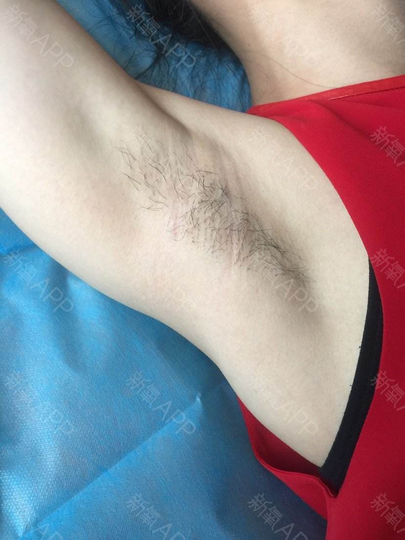 脱腋毛方法,女生如何正确脱腋毛