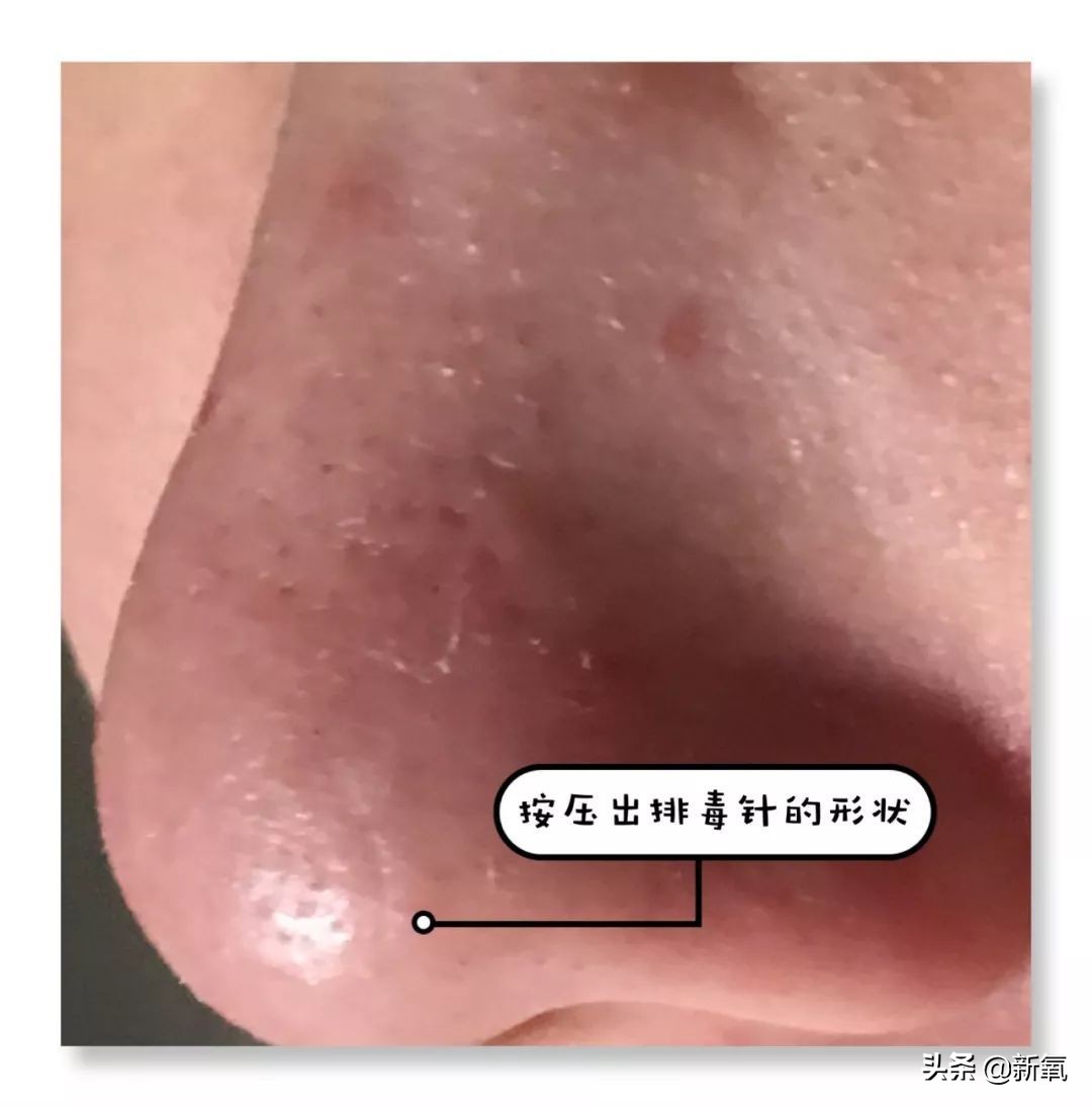 五分钟教你有效去黑头,最火去黑头收缩毛孔