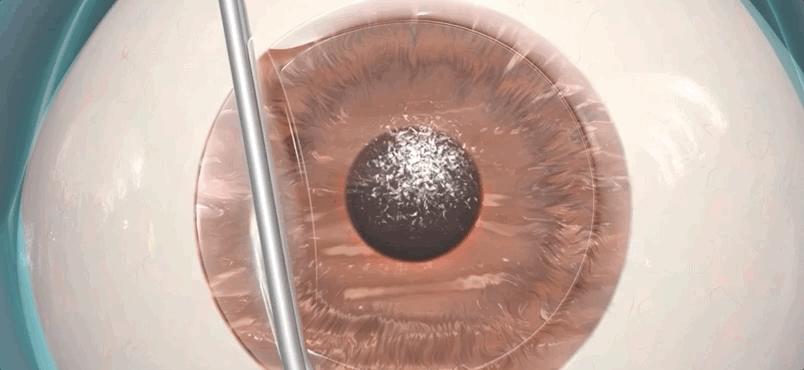 激光近视矫正手术有什么后遗症,激光矫正近视和散光有什么后遗症