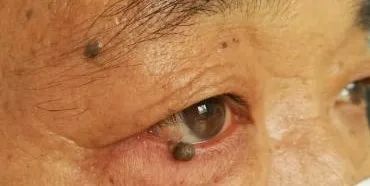 眼整形修复权威科普,科普眼整形手术是个什么手术多图