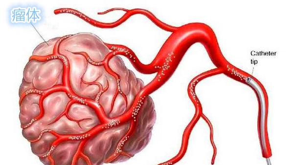 卵巢癌晚期中药治疗成功案例,奥拉帕利治疗卵巢癌晚期效果好吗