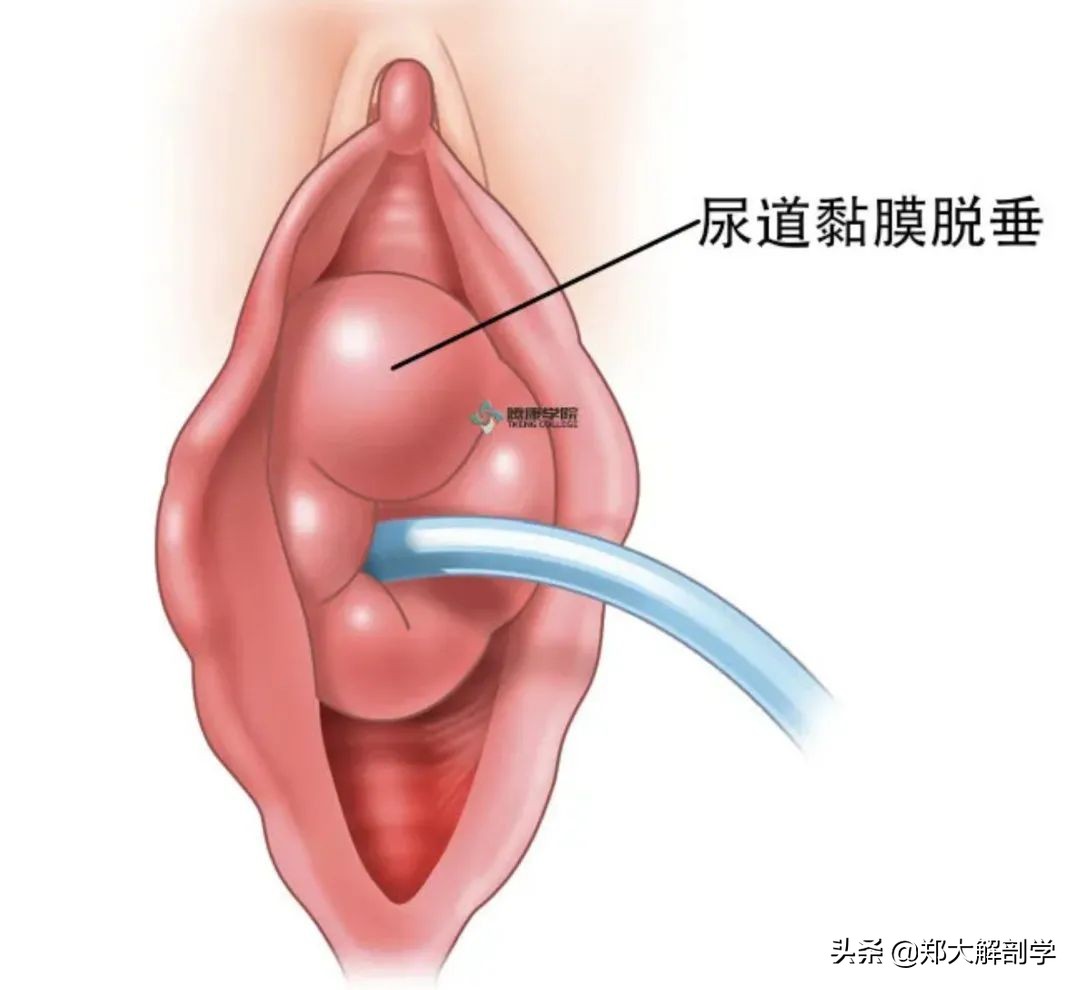 女性盆底功能障碍性疾病表现,盆底功能障碍会引起失眠吗