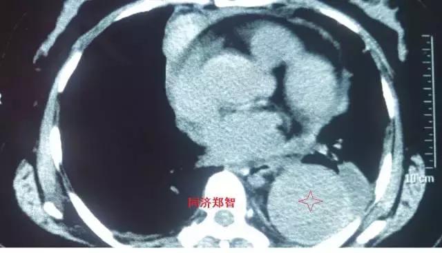 磁共振可以替代cta检查主动脉夹层,主动脉夹层cta上如何分辨真假腔
