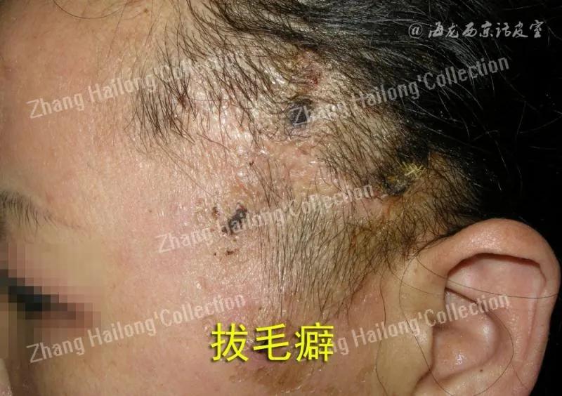 拔毛癖是因为压力吗,拔毛癖是心理问题吗