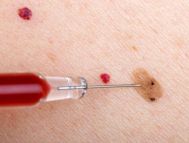 肝硬化蜘蛛痣什么情况会出现,出现蜘蛛痣了肝硬化到什么程度