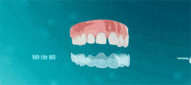 隐适美矫正和国产隐形矫正区别,隐适美隐形矫正器