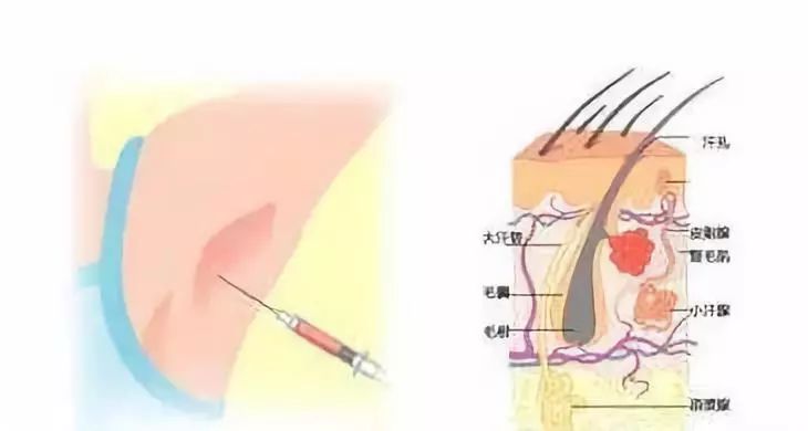 夏天到了有腋臭怎么办,腋臭止汗剂用哪个牌子不刺激过敏