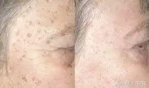 遗传斑祛斑最有效方法,斑怎么祛除最快最有效