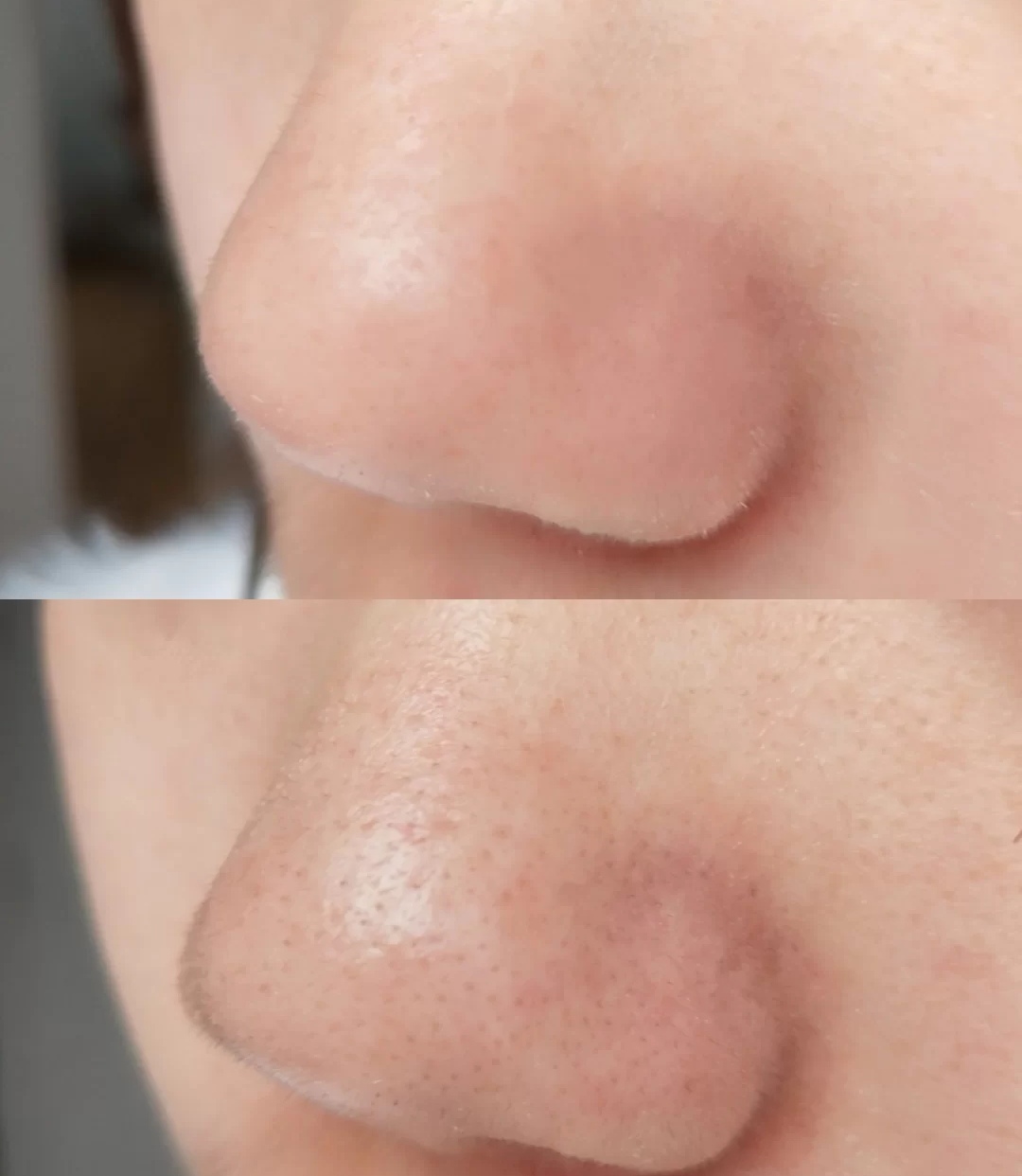 新手刷脂一个月的变化,干皮新手a醇精华