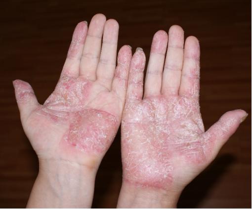 手上起水泡奇痒反复复发,手上频繁起癣