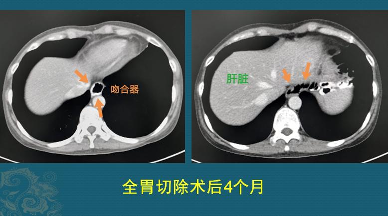 32岁女子抗癌19年相继患上5种癌,癌细胞转移最难治疗方法