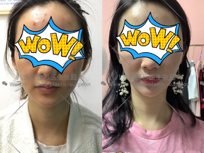 八大处整形张超,八大处张超最新视频